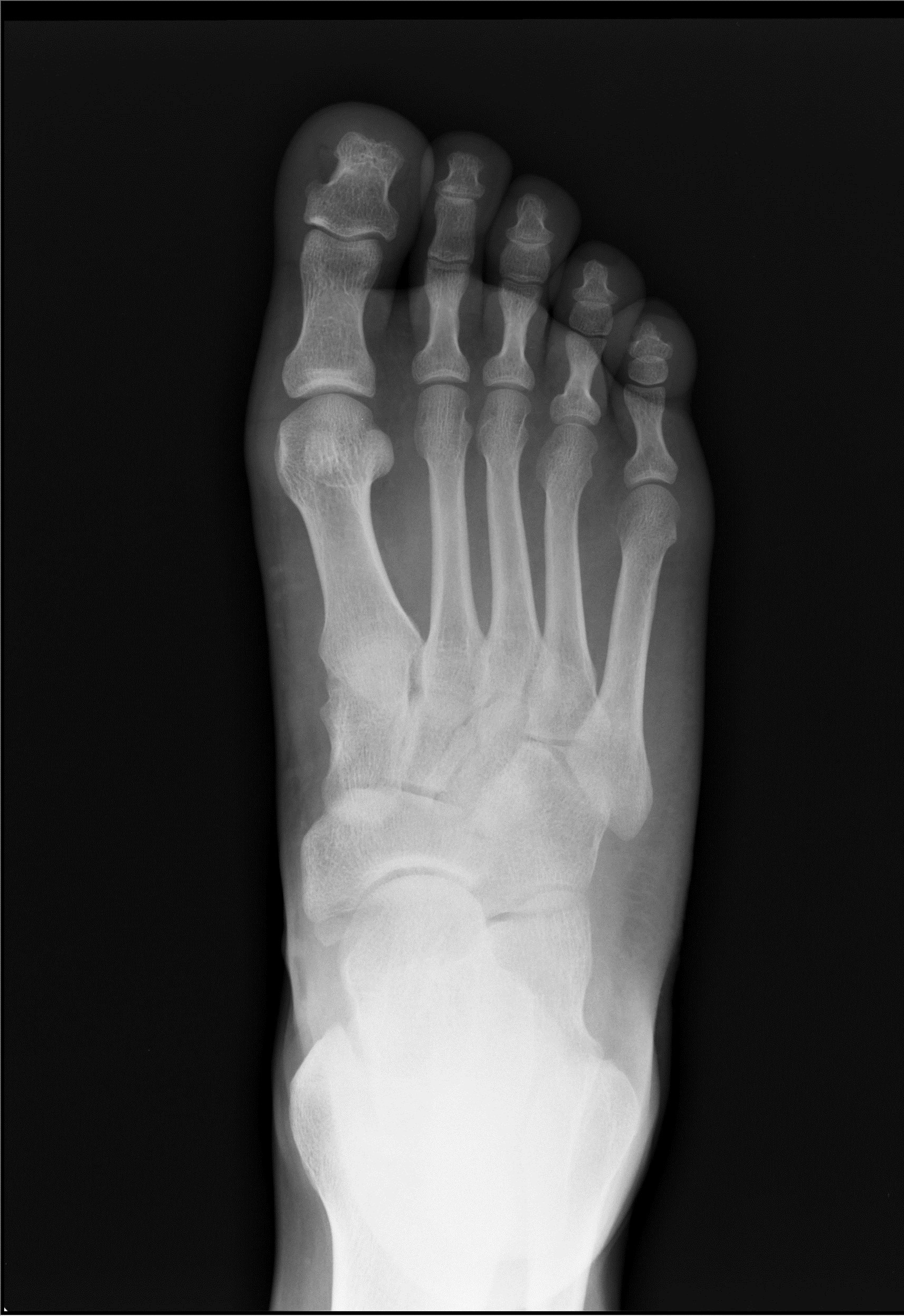 X-ray of foot